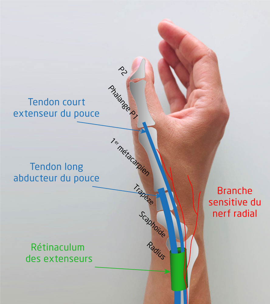 Tendinite de De Quervain: tendinite au poignet - Membre-Superieur